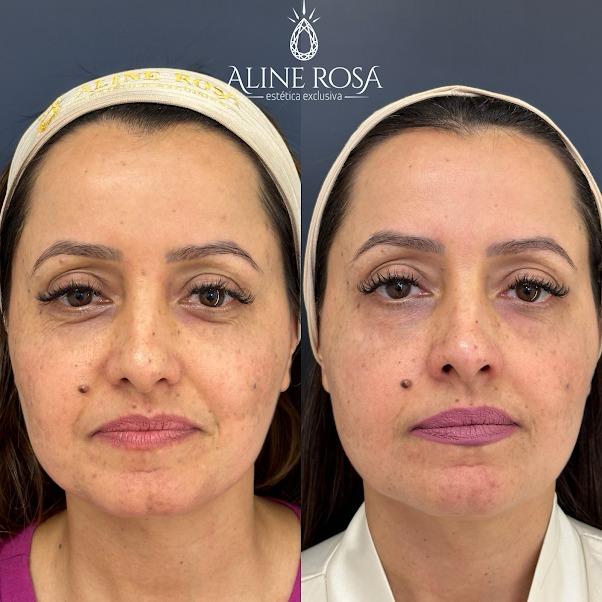 Gerenciamento de Melasma